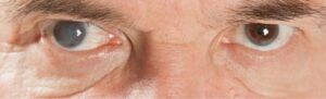 La Cataracte Définition Causes et Symptômes